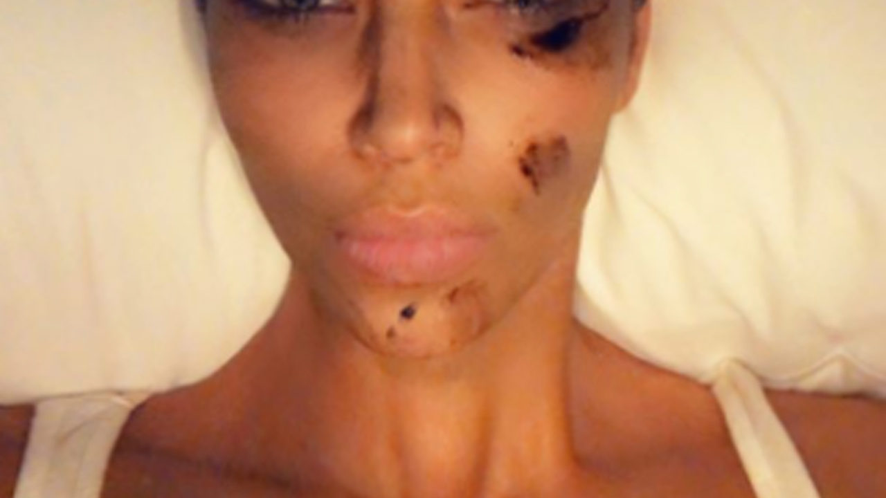 Kim Kardashian Conceals Her Psoriasis With Body Makeup! - Perez Hilton