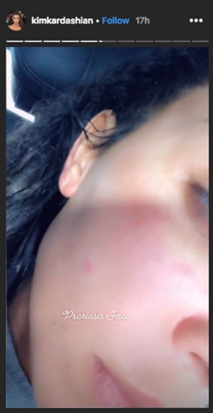 Kim Kardashian shows off her psoriasis on Instagram Stories.