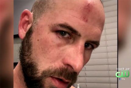 Taco Bell victim Brian Reese shows his injuries.