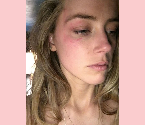 Amber Heard hit with phone