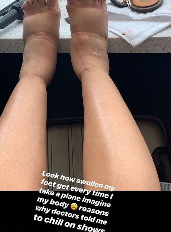 Cardi B Reveals Plastic Surgery Side Effects Witha A Photo Of Her Severely Swollen Feet Look Celebritytalker Com