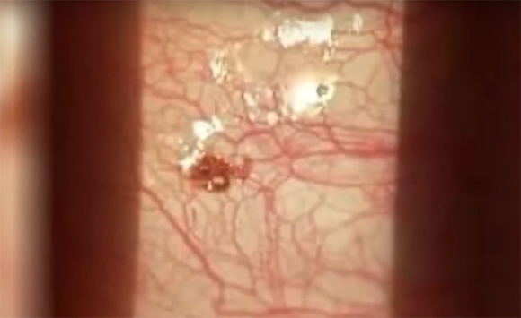 Tick in man's eye