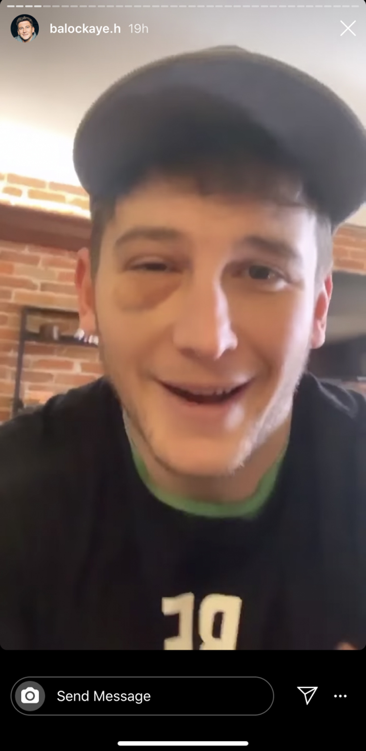 'Bachelorette' Alum Blake Horstmann Suffers Black Eye & Broken Facial