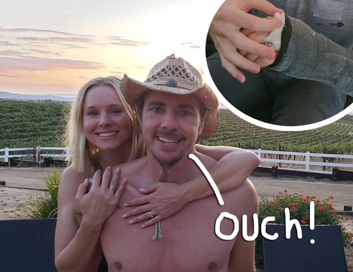 dax shepard injures his hand during a