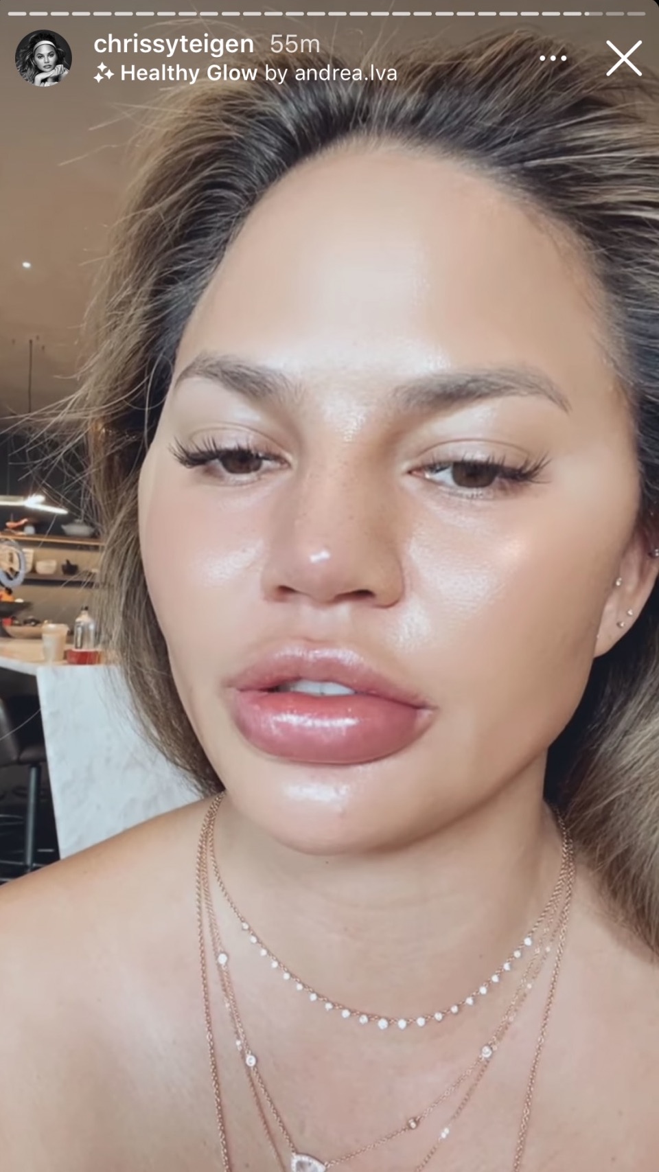Chrissy Teigen Shares Swollen Lips On IG Story