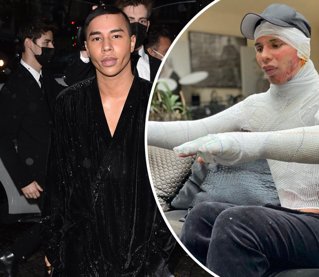 Balmain Olivier Reveals He Was Severely Burned Last Year After A Fireplace Explosion Perez Hilton