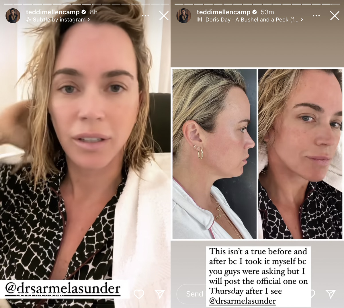 Teddi Mellencamp Reveals Why She Got A Neck Lift -- And Blasts Critics!