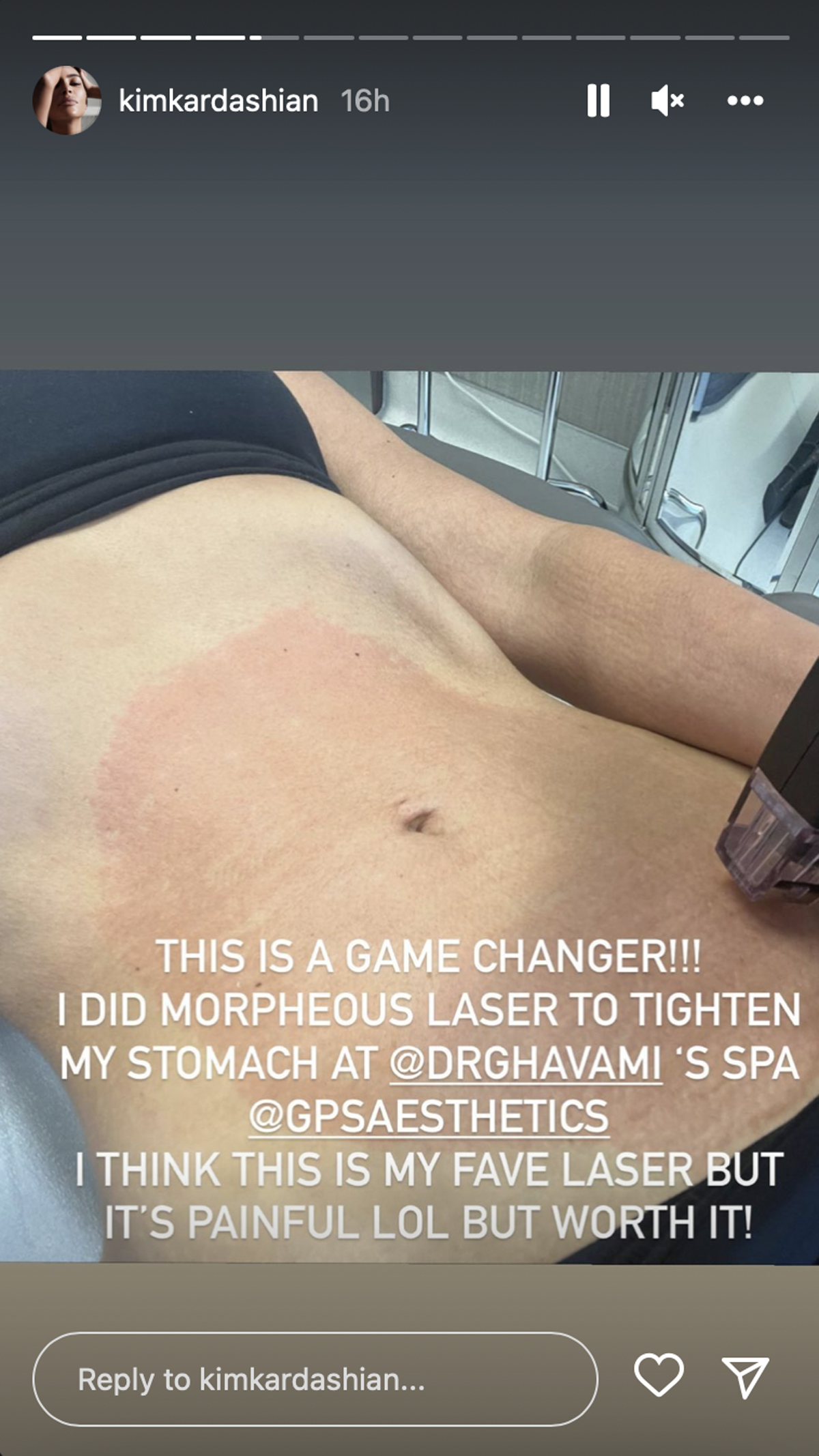 Kim Kardashian's Company SUED After 'Customer' Claims 'Dangerous' Body Tape Ripped  Off Skin - See SKIMS' Response HERE! - Perez Hilton