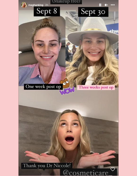 Meghan King Instagram Story updated swelling comparison surgery