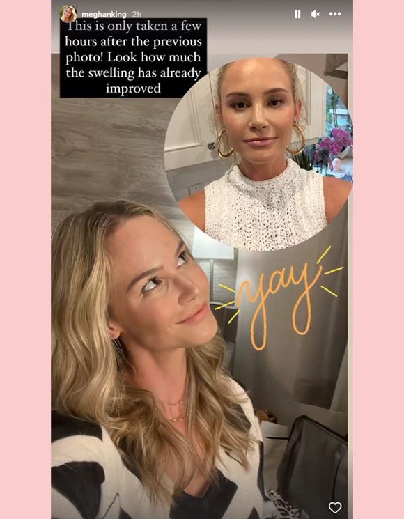 Meghan King Instagram Story surgery updates finished nosejob