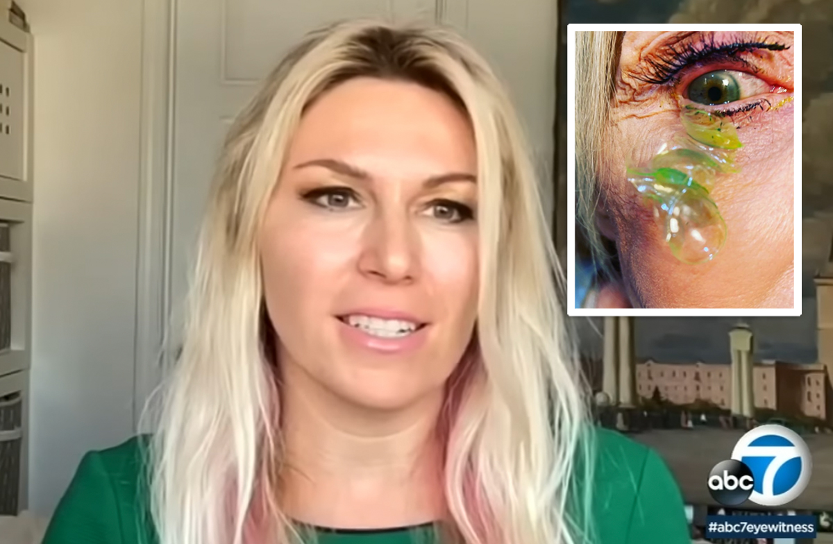 #OMG?! Ophthalmologist Discovered Her Patient Had 23 Contact Lenses Lodged Underneath Her Eyelid!