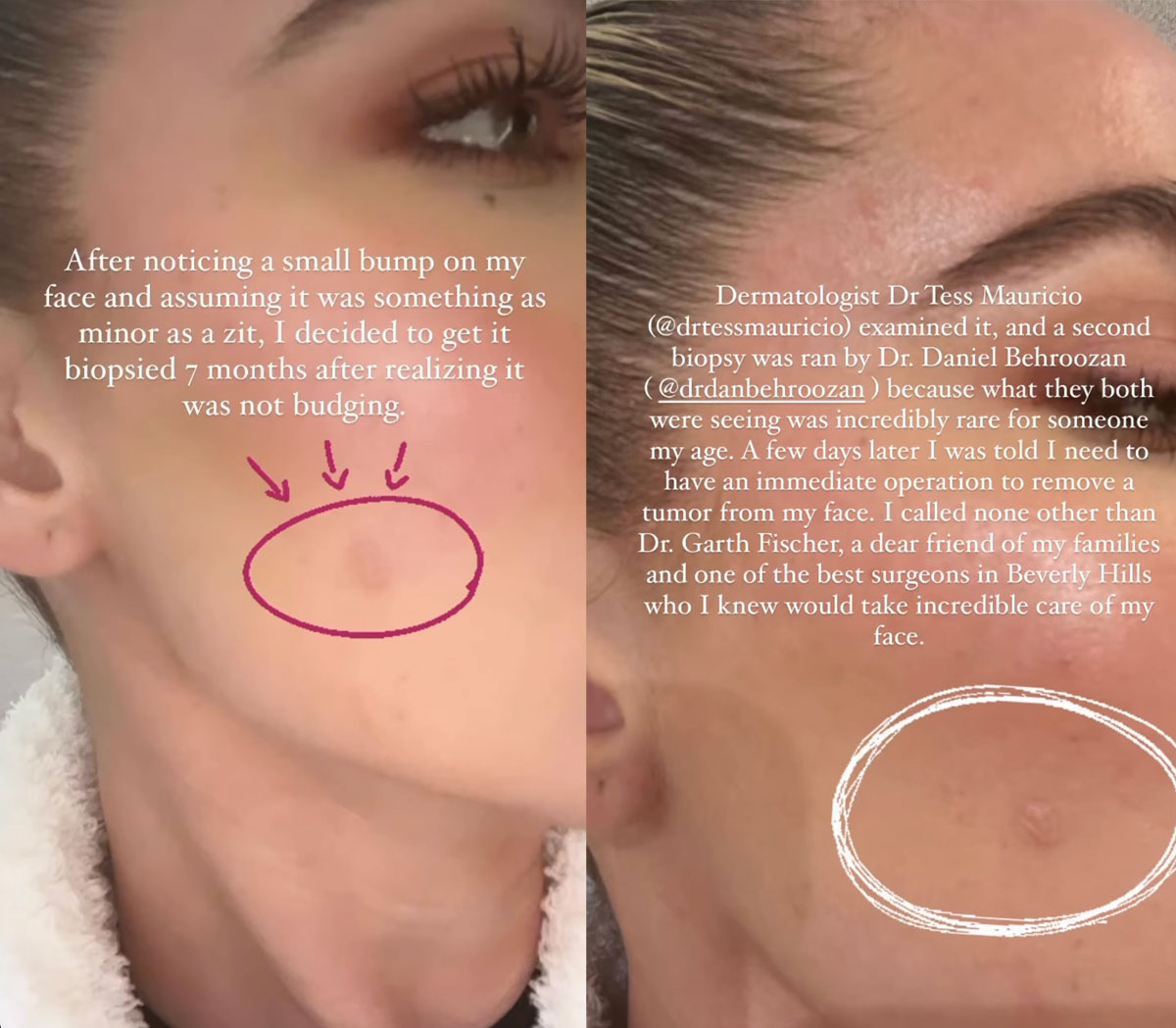 Khloé Kardashian Details Getting A TUMOR Removed From Her Face!!