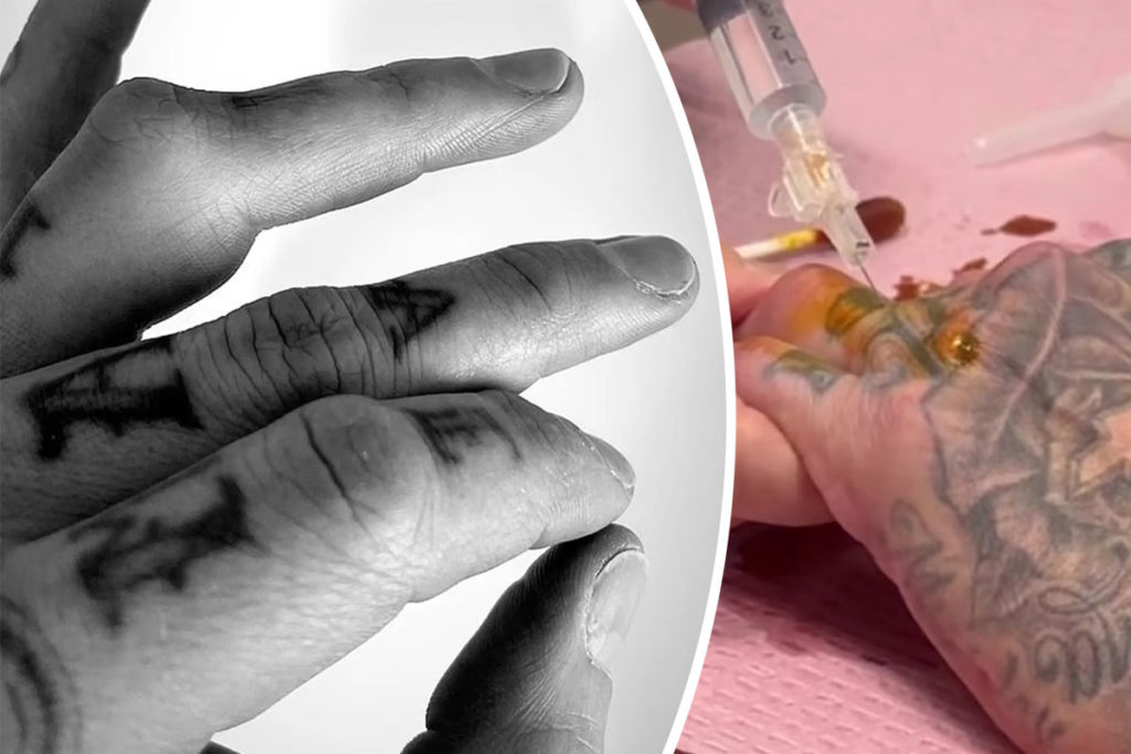 Travis Barker Reveals Graphic Photo Of Finger Injury Ahead Of Blink182