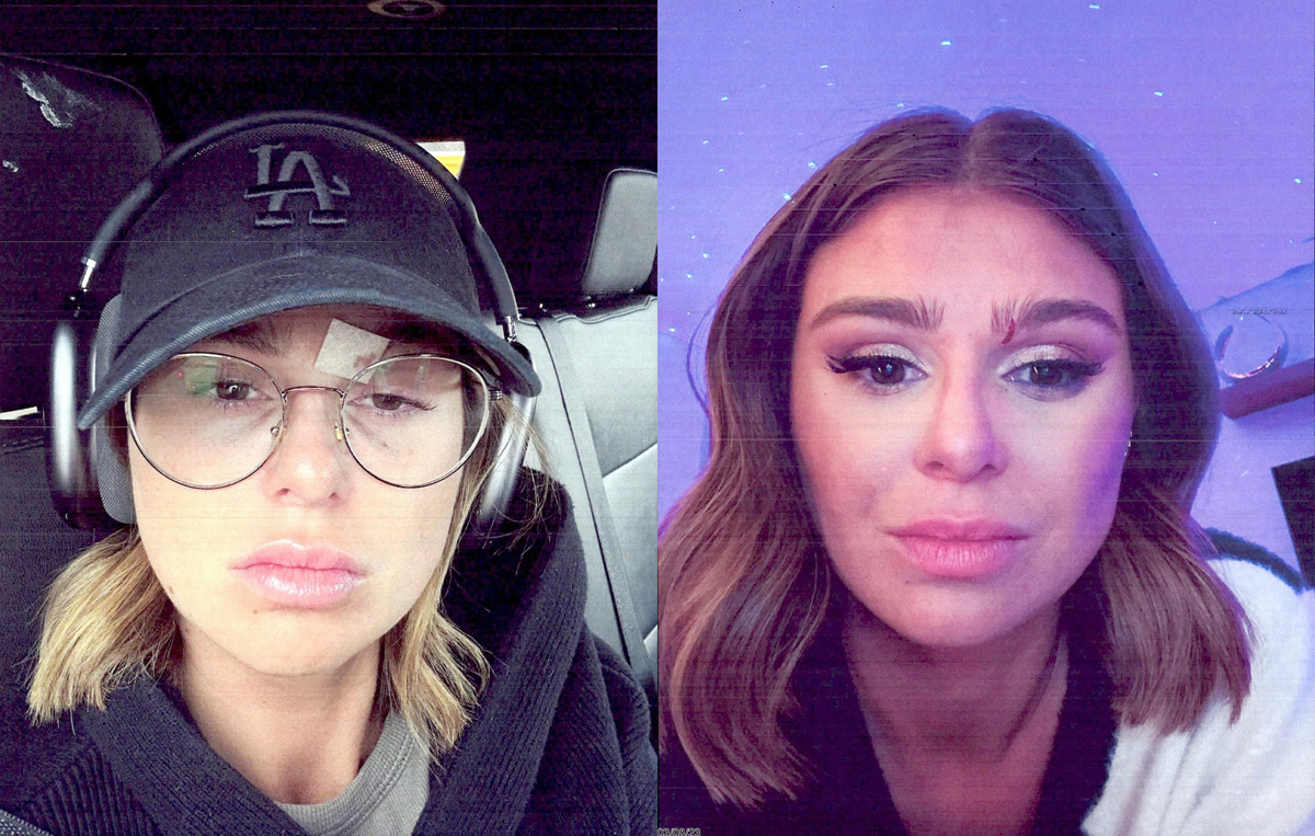 Raquel Leviss Reveals Injury To Her Eye From Scheana Shay Punch