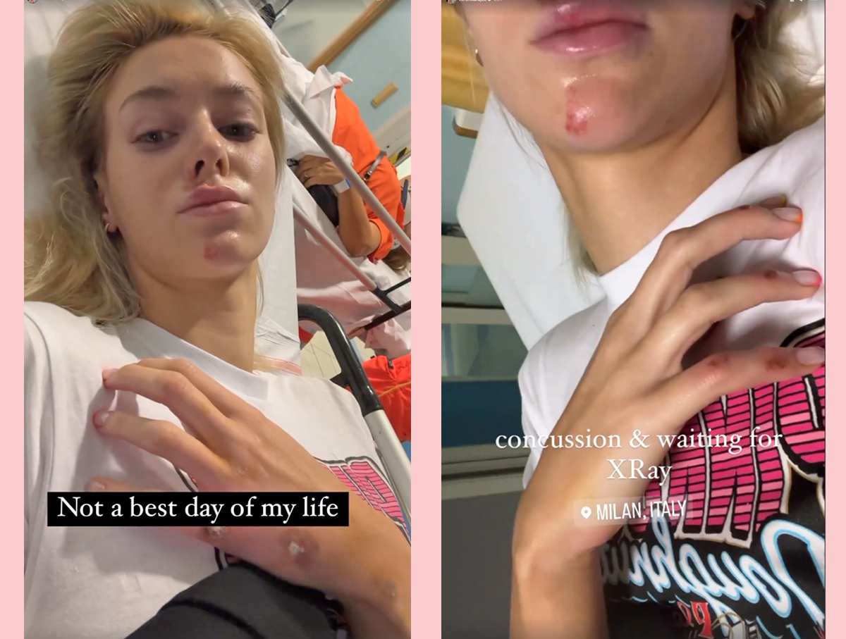 Model Veronika Rajek Reveals Painful Face Injuries After Scooter Crash! -  Perez Hilton