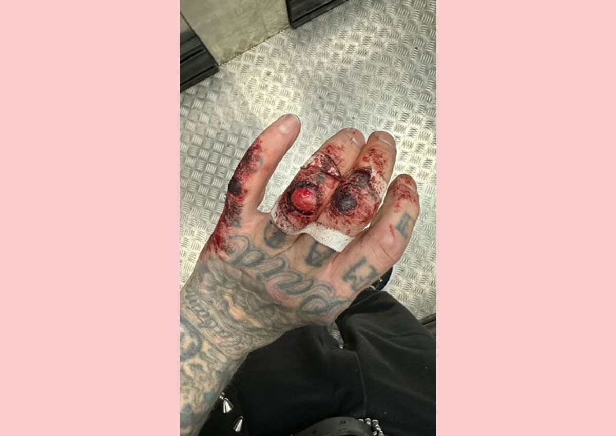 travis barker hand injury