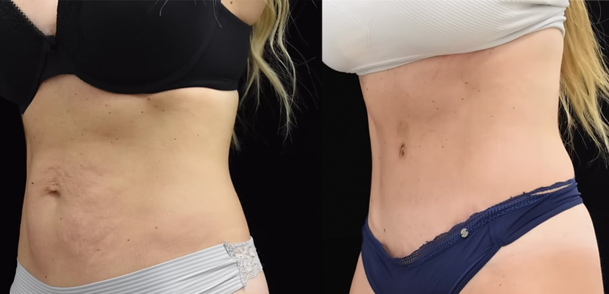 Real Housewives Of New Jersey Star Gives Fans Closeup Of Her Tummy Tuck Results! LOOK!