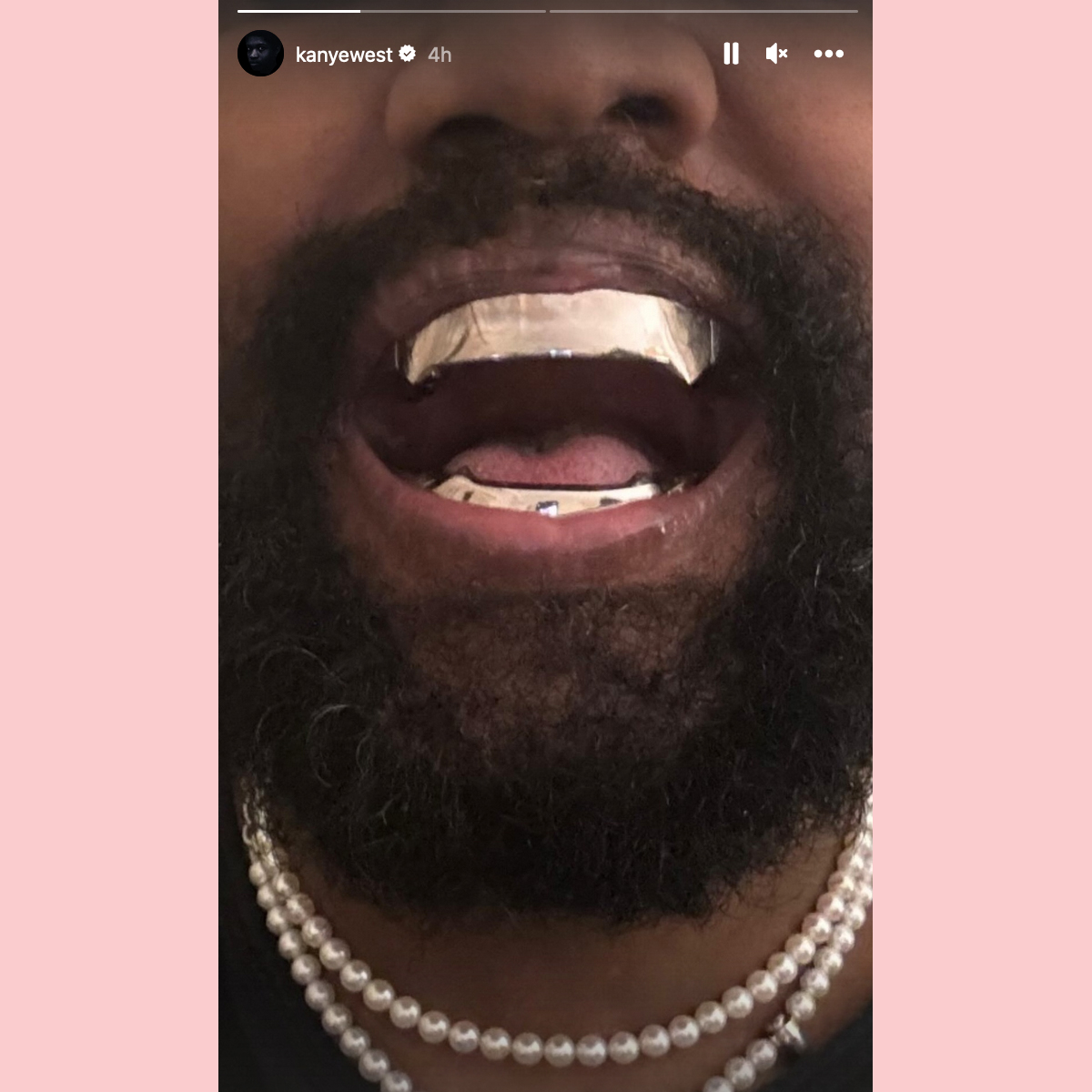 Kanye West Shows Off Titanium Teeth