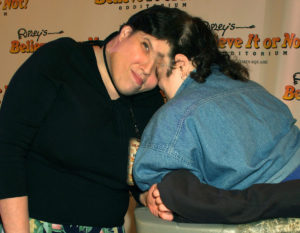 World’s Oldest Conjoined Twins Lori & George Schappell Dead At 62