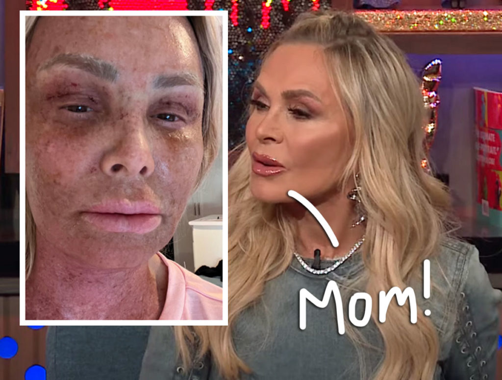 Tamra Judge Gets ROASTED By Mom Over Plastic Surgery Recovery: ‘Your Face Literally Makes Me Want To Throw Up'