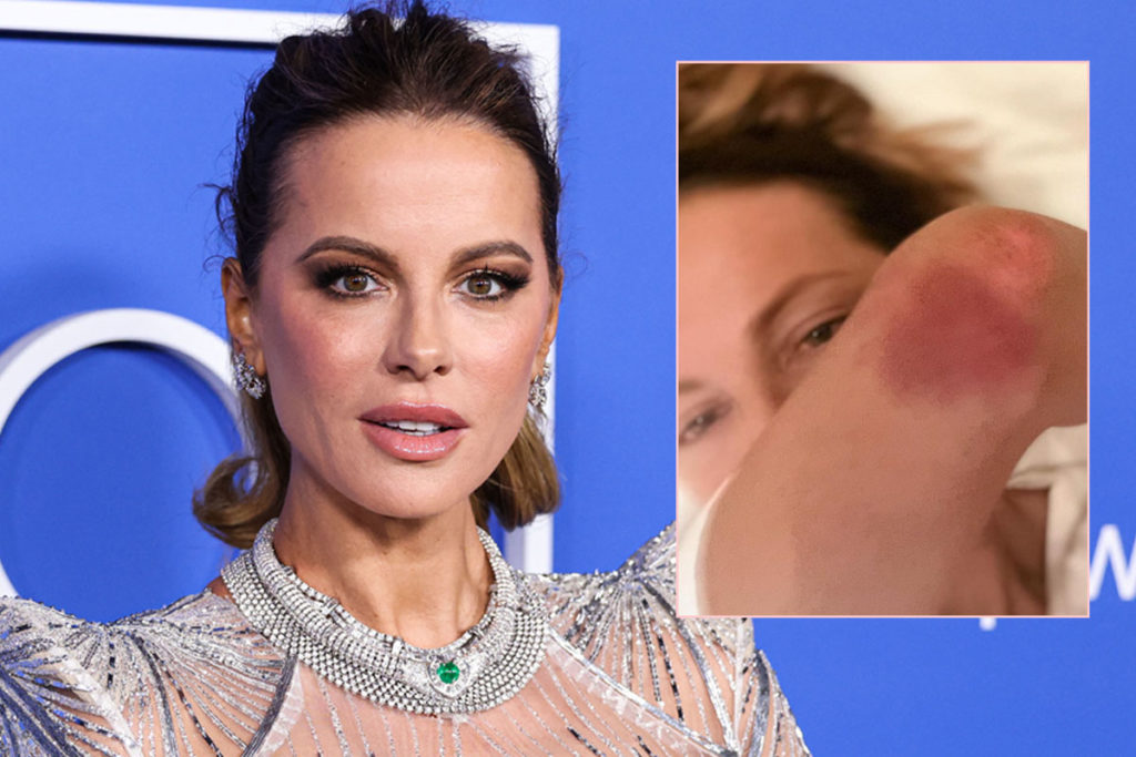 Kate Beckinsale Sparks Fan Concern After Sharing Brutal Injury Pics!