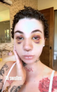 Bhad Bhabie Reveals She Got Nose Job And Clarifies Cancer Diagnosis