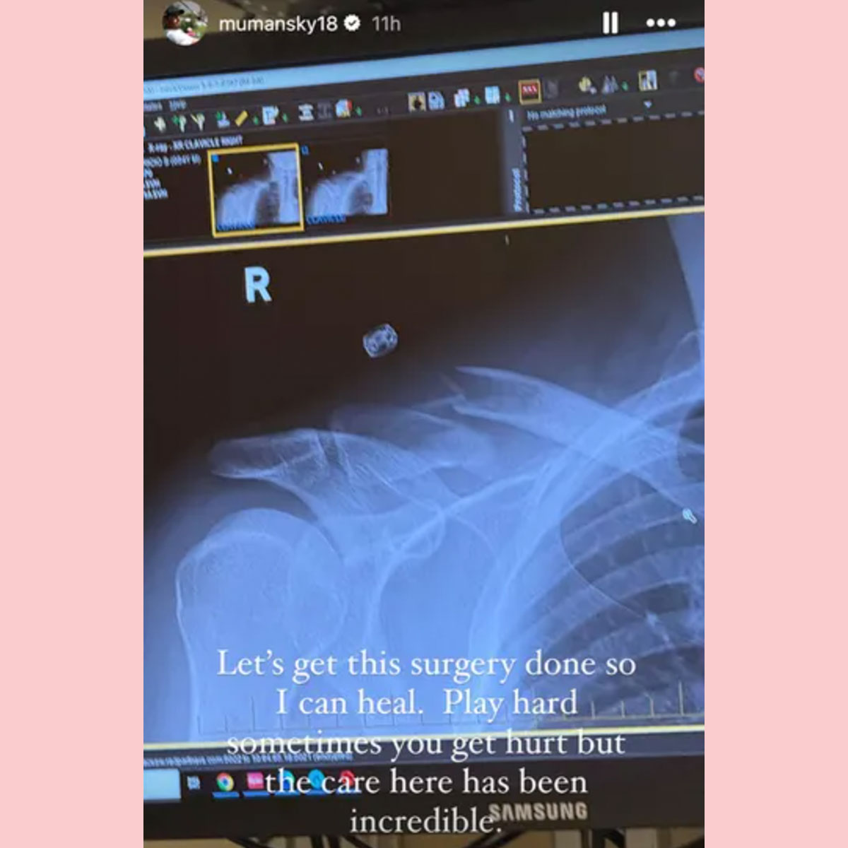 Mauricio Umansky broke his clavicle while skiing