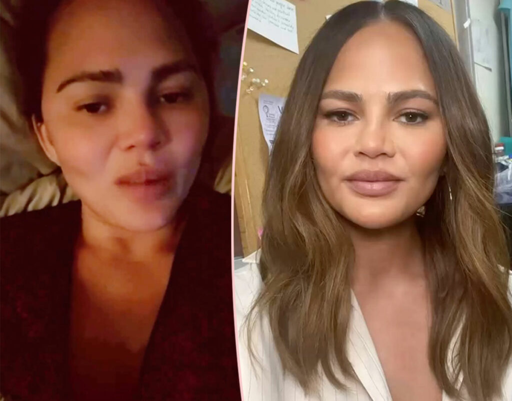 Chrissy Teigen Claps Back At Criticism Of Her Cheek Filler: 'Stop Being Miserable'