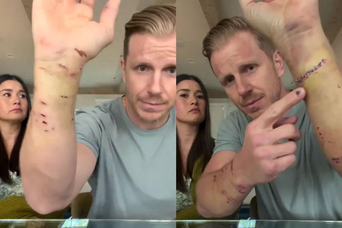 Sean Lowe shows wounds from dog attack
