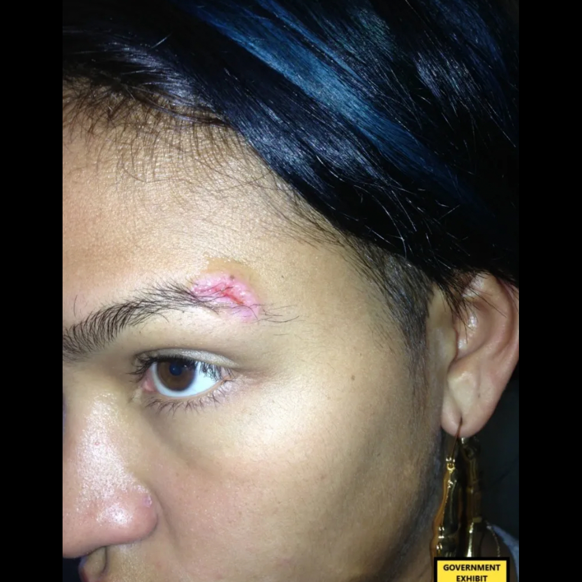 Cassie Injury Photos eyebrow 1