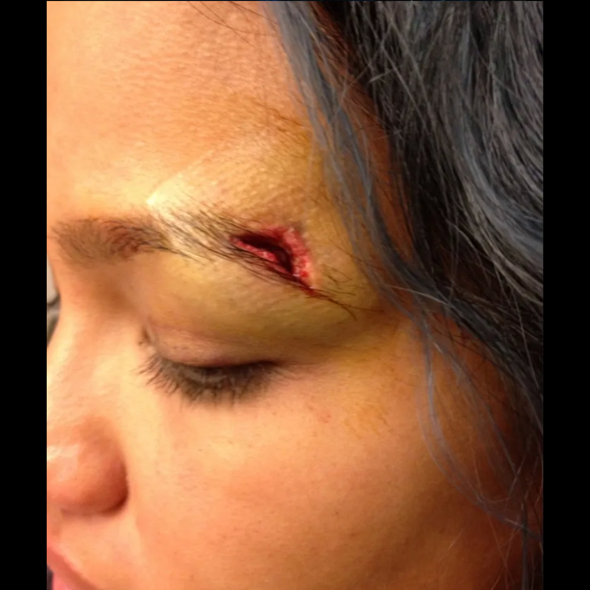 Cassie Injury Photos eyebrow 2