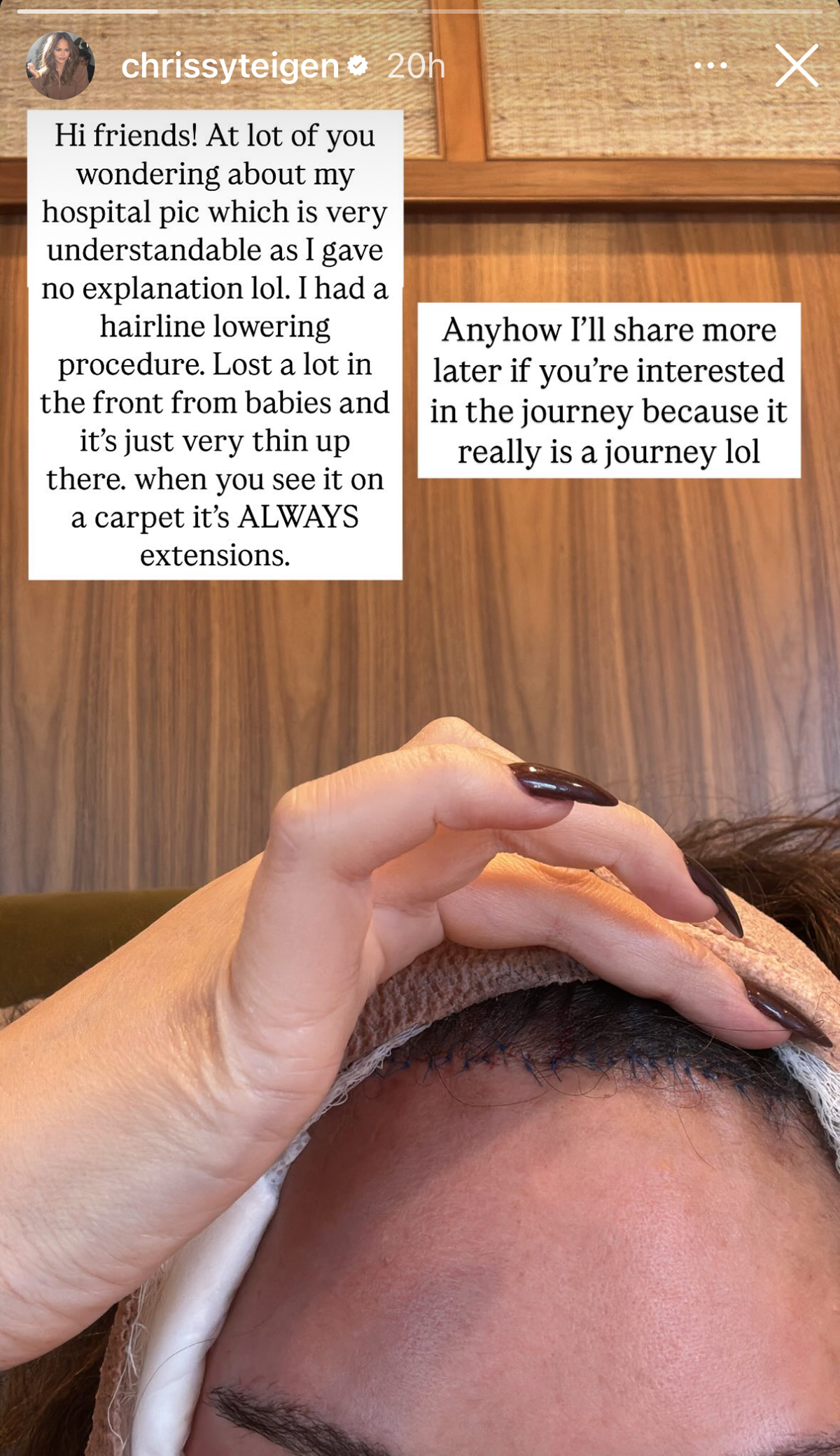 Chrissy Teigen Breaks Her Silence After Sparking Concern With Photo Of Bandaged Face!