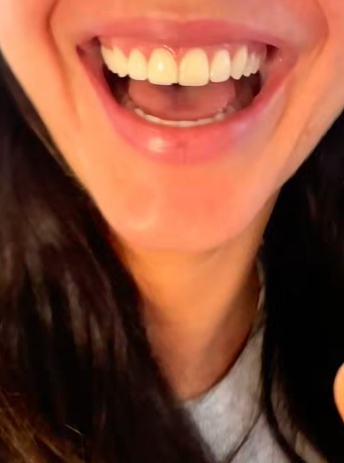 Kendall Jenner Chipped Her Front Tooth On The Way To The Knicks Game! Oh No!