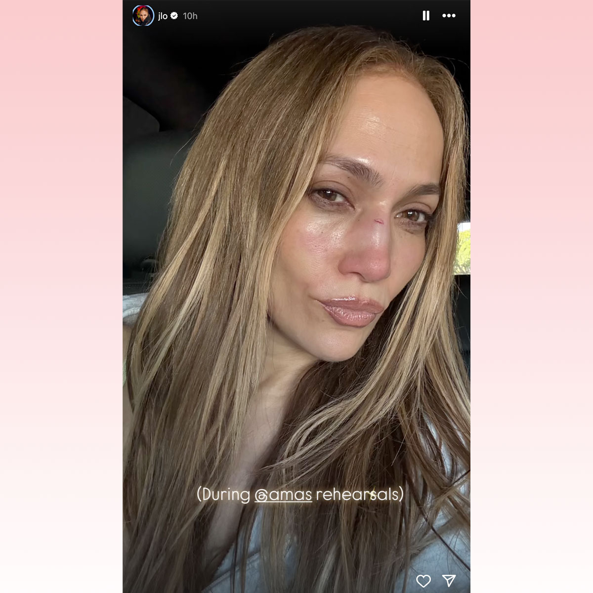 Jennifer Lopez reveals facial injury from AMAs rehearsals
