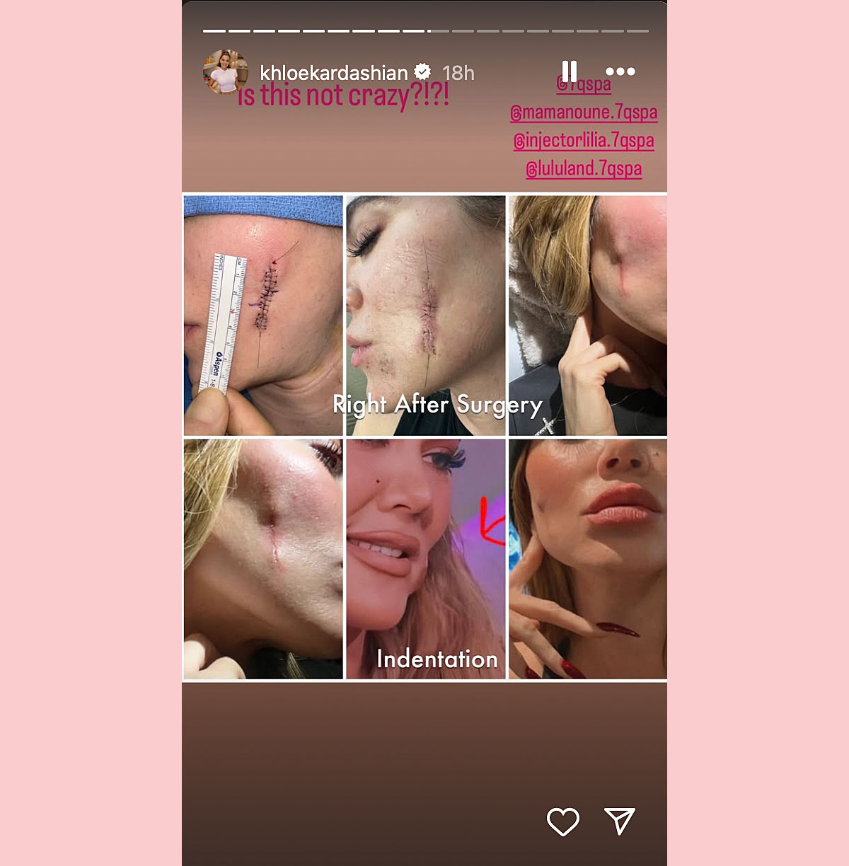 Khloe kardashian before and after skin cancer