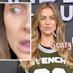 Lala Kent Says She's Taking Chemo Drops For Pre-Cancerous Growth On Her Eye! Oh No!