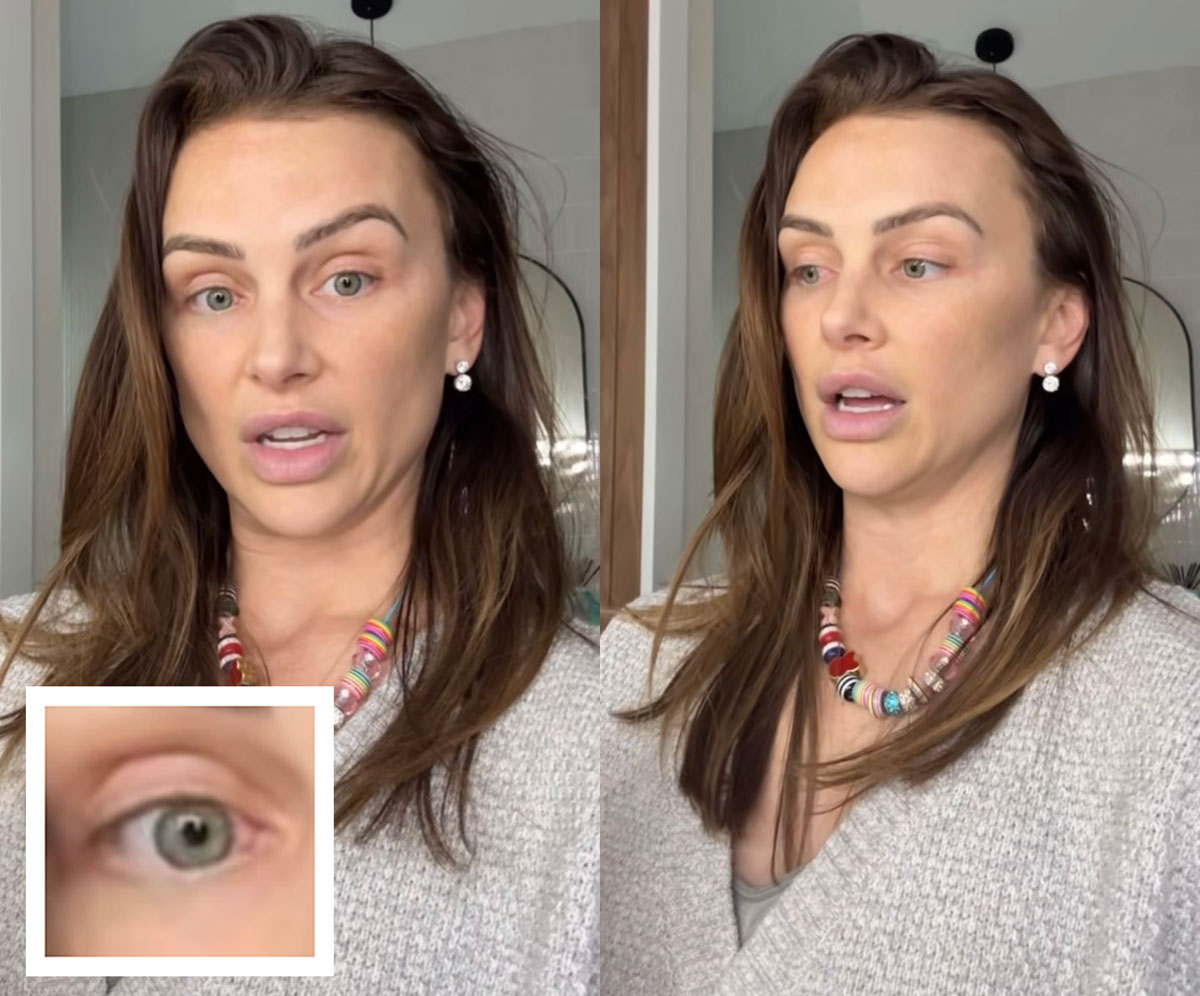 Lala Kent Says She's Taking Chemo Drops For Pre-Cancerous Growth On Her Eye! Oh No!