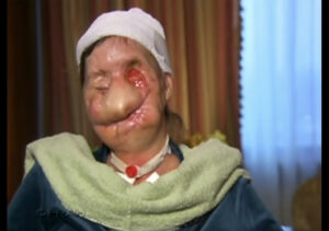 Woman Whose Face Was Ripped Off By Chimp In 2009 Reveals What She Looks
