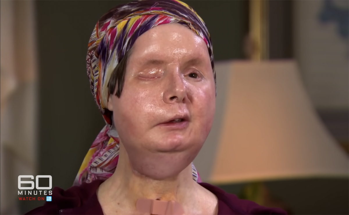 Charla Nash now after face transplant