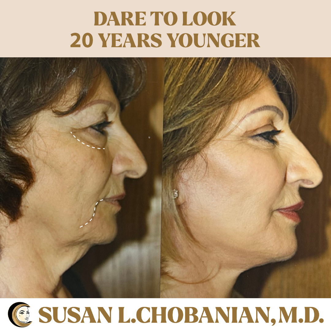 Susan Chobanian makes clients look younger