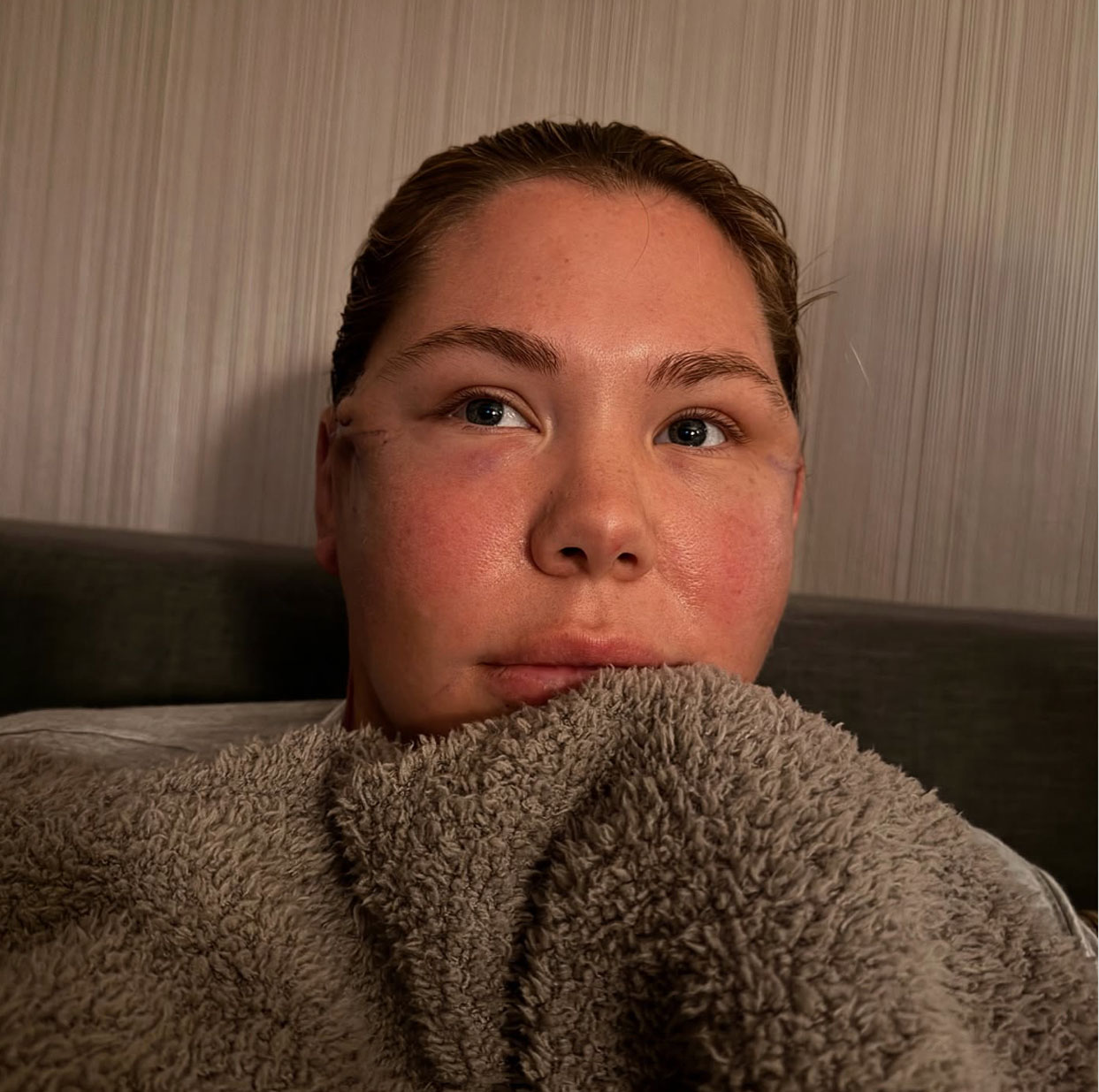 Kailyn Lowry double chin surgery before and after