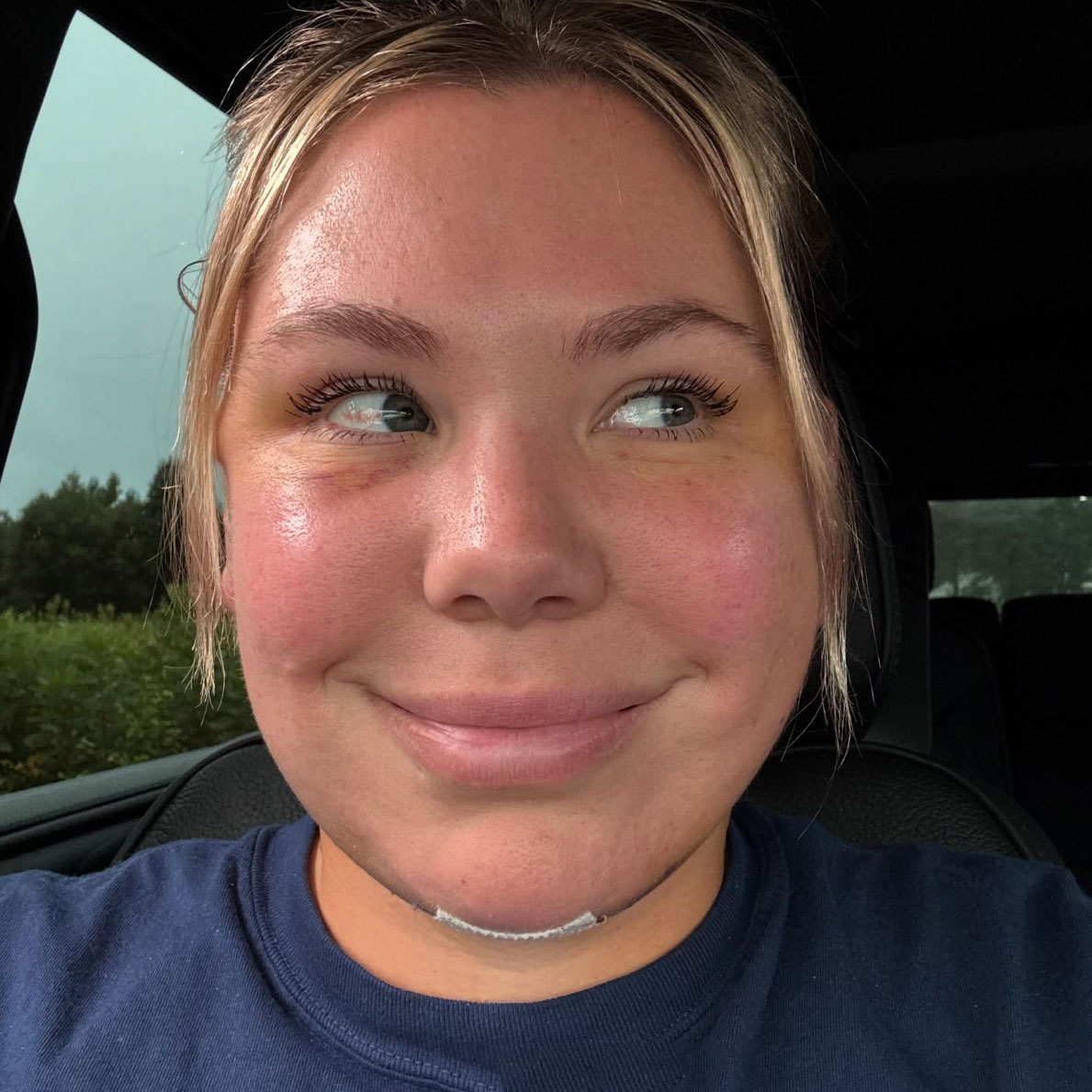 Kailyn Lowry double chin surgery before and after