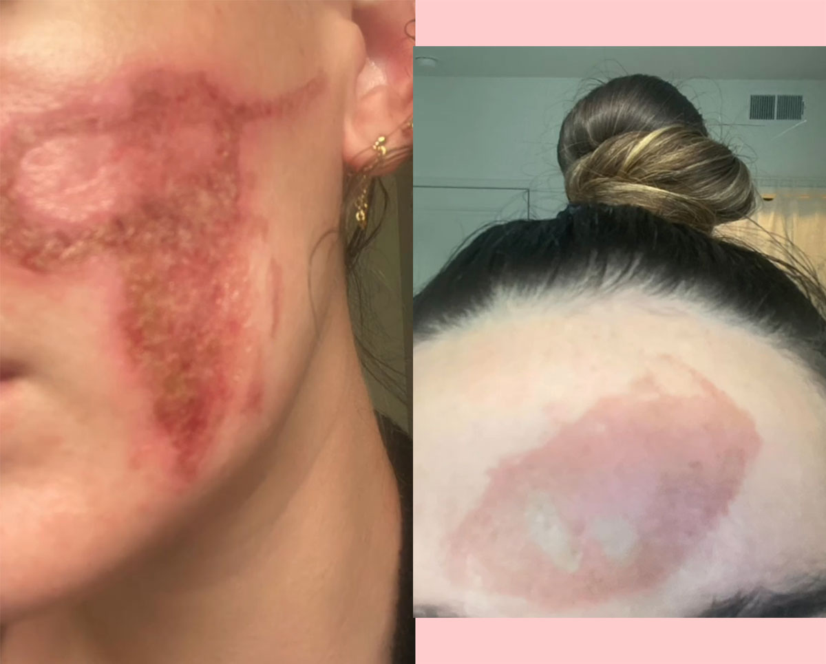 Celebrity Facialist Accused Of Permanently Scarring Woman's Face!