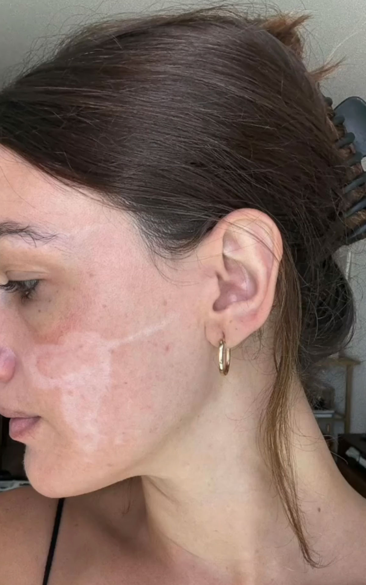 Celebrity Facialist Accused Of Permanently Scarring Woman's Face!
