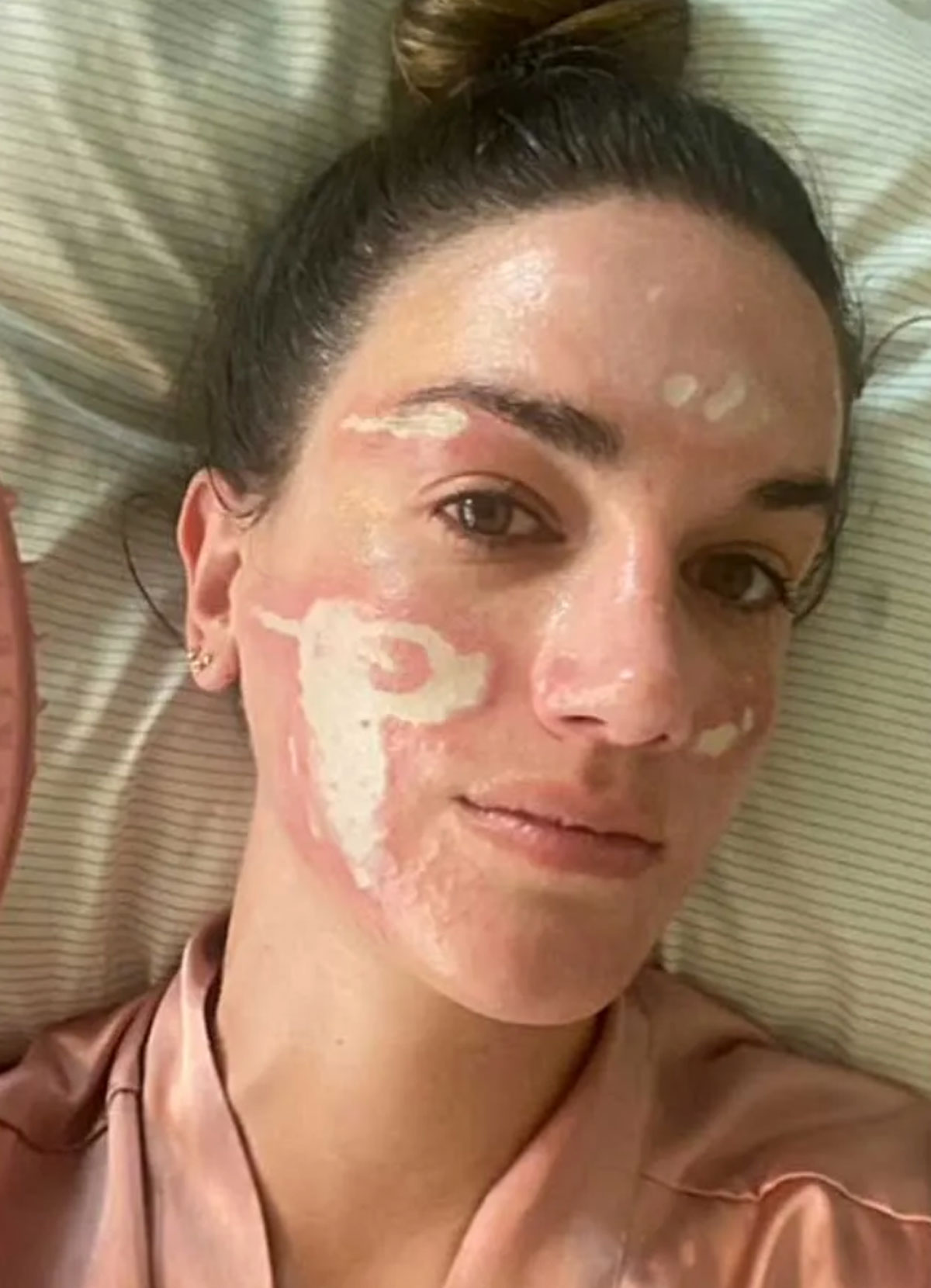 Celebrity Facialist Accused Of Permanently Scarring Woman's Face!