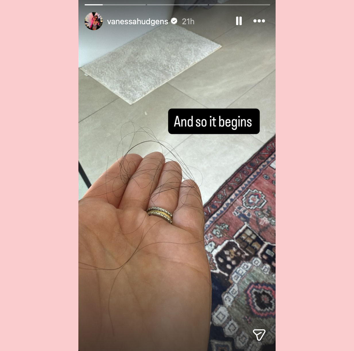 Vanessa Hudgens Gets Candid About Suffering THIS Tough Postpartum Symptom!