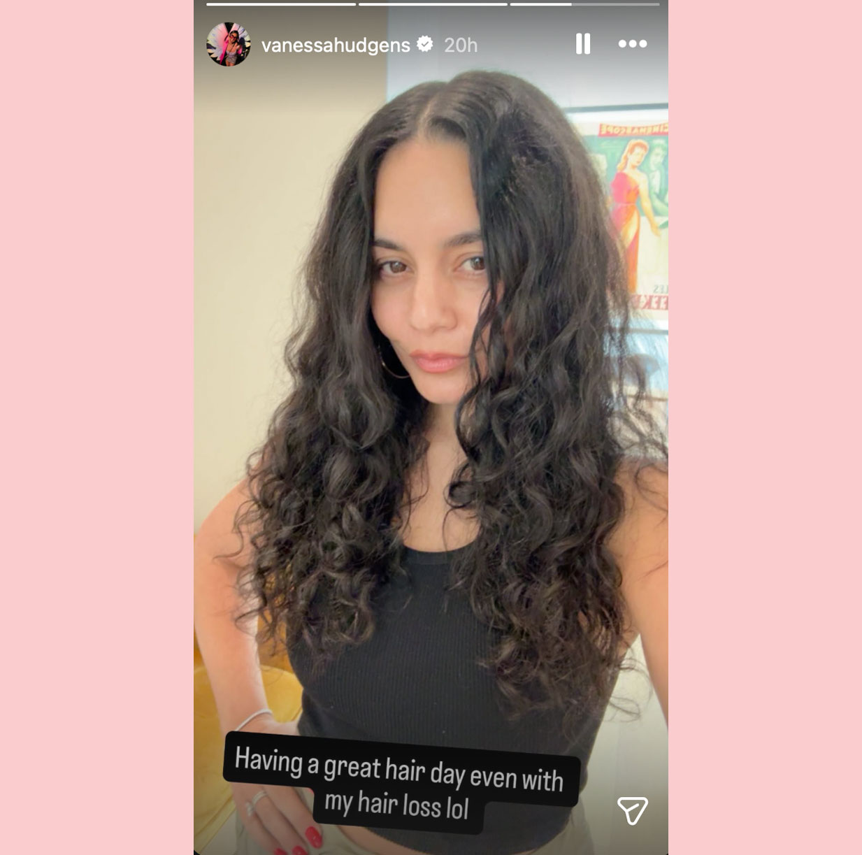 Vanessa hudgens postpartum hair loss