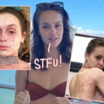 Mikayla Matthews BLASTS People 'Minimizing' Her Chronic Skin Issues As 'Just Rashes' -- Says It Can Take 'Your Will To Live'