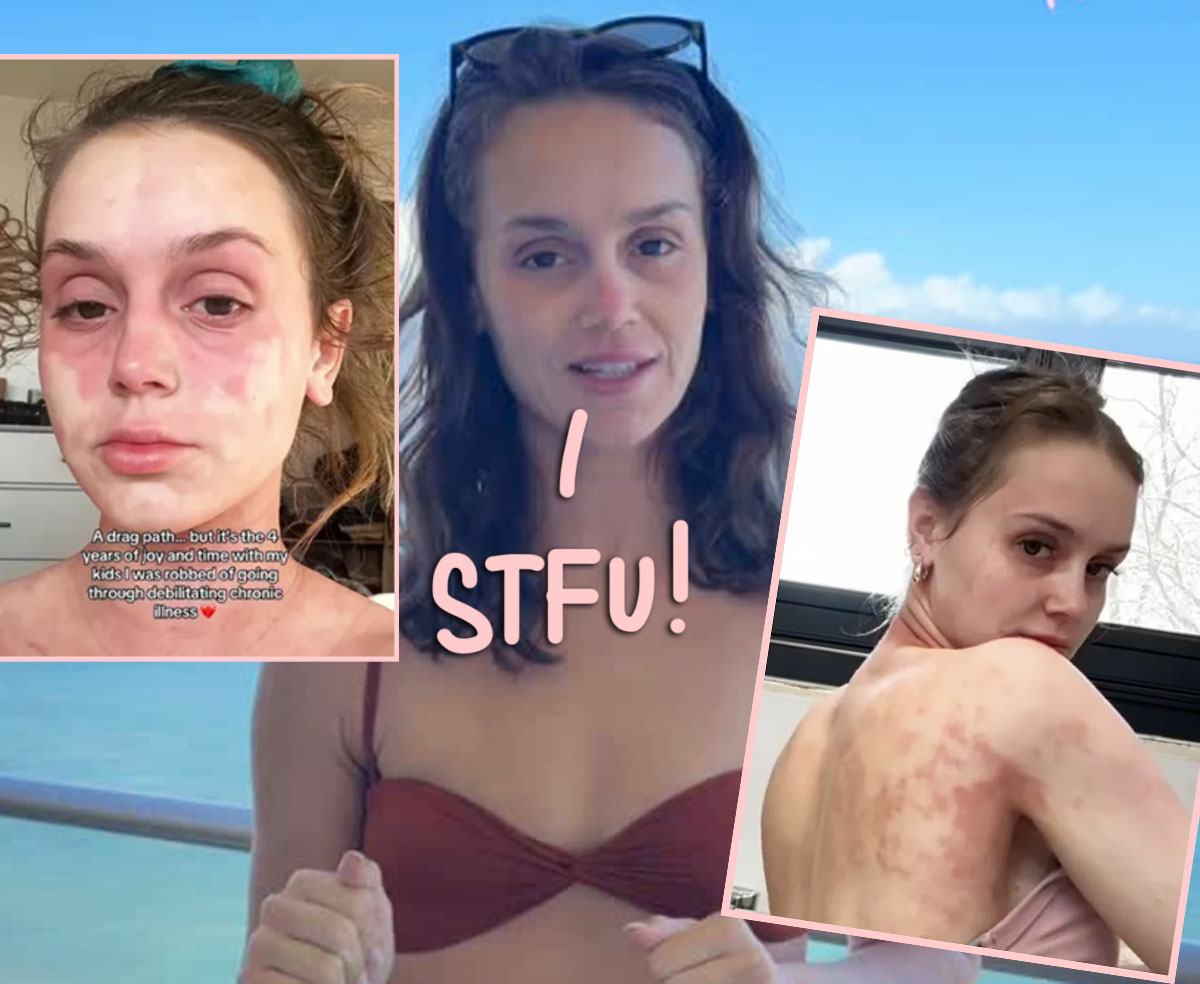 Mikayla Matthews BLASTS People ‘Minimizing’ Her Chronic Skin Issues As ‘Just Rashes’ — Says It Can Take ‘Your Will To Live’