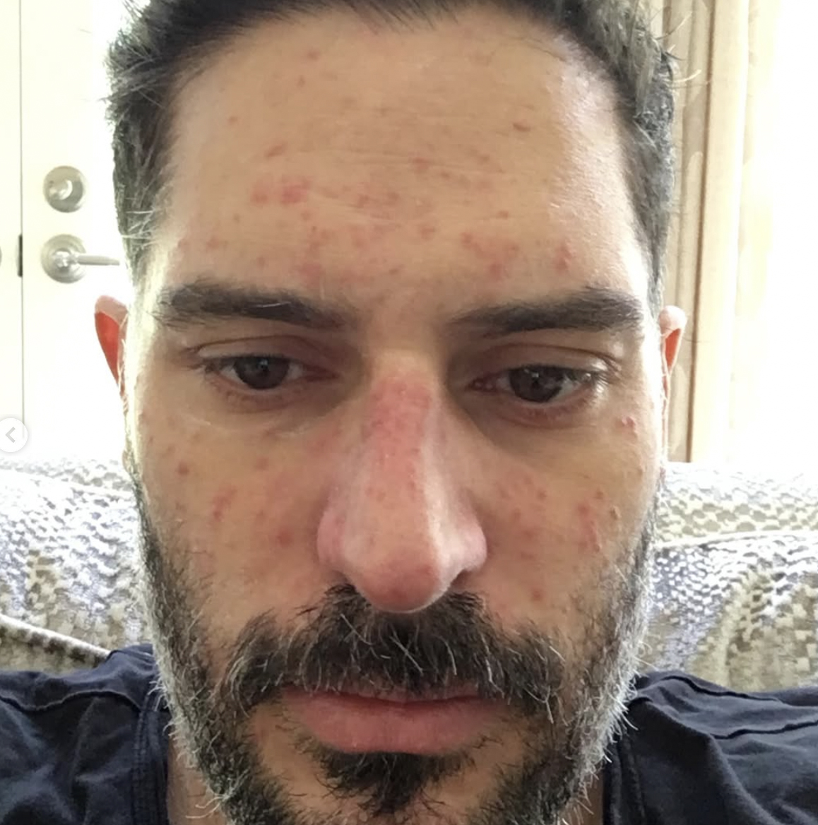 Joe Manganiello face skin breakout